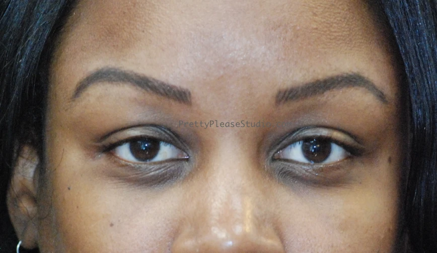 Different Tattoo Removal Methods