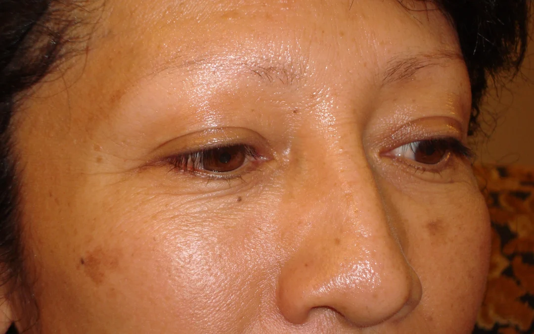 Alopecia: More Than Just Hair Loss