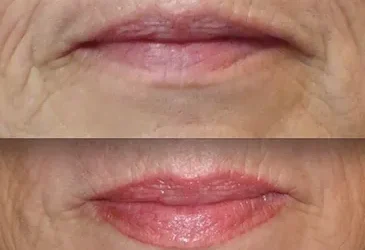 Cold sores, herpes (HSV-1) for Lip Permanent Makeup Procedures