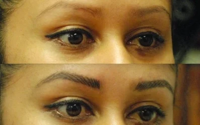 Tattoo Lightening vs. Tattoo Removal