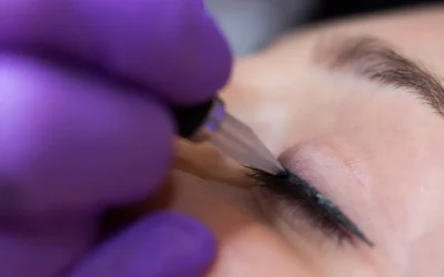Dark ring around lips from permanent makeup lip procedure